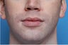 24 Year Old Male Treated For A Weak Jawline