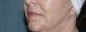 Face and neck Fraxel repair with C02/Erbium lasers for upper lip wrinkles
