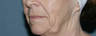 Face and neck Fraxel repair with C02/Erbium lasers for upper lip wrinkles