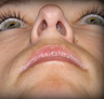 Rhinoplasty