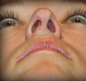 Rhinoplasty