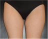 SmartLipo MPX