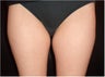 SmartLipo MPX