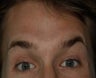Male treated for Forehead Wrinkles