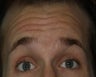 Male treated for Forehead Wrinkles