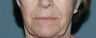Wrinkle Reduction with Laser Resurfacing