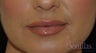 38 y/o female desired fuller lips with filler.