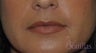 38 y/o female desired fuller lips with filler.