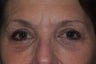 Ptosis Repair with combined Lower Lid Blepharoplasty