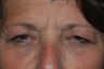Ptosis Repair with combined Lower Lid Blepharoplasty