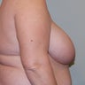 Breast Reduction