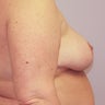 Breast Reduction