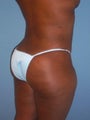 Brazilian Butt Lift