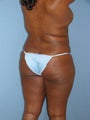 Brazilian Butt Lift