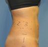 Liposonix