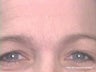 Frown Line Treatment