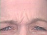 Frown Line Treatment
