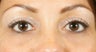 Filler for Under-eye circles (tear troughs)