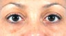 Filler for Under-eye circles (tear troughs)