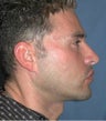 Chin Augmentation