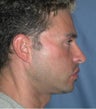 Chin Augmentation