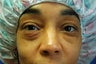 lower eyelid lift