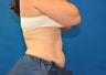 CoolSculpting