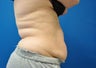 CoolSculpting