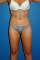 liposuction body
