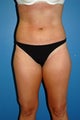 liposuction body