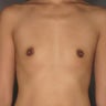 30 Year Old Female Breast Augmentation: Silicone Gel Implants