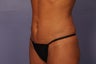 42 yr old wanting a mommy makeover