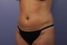 42 yr old wanting a mommy makeover