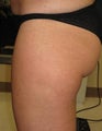 truSculpt