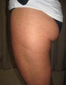 truSculpt