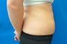 CoolSculpting