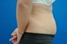 CoolSculpting