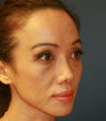 Two weeks after rhinoplasty