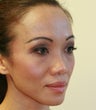 Two weeks after rhinoplasty