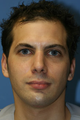 Otoplasty