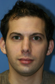 Otoplasty