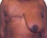 Breast Reconstruction
