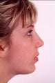 Rhinoplasty and Chin Implant