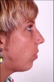 Rhinoplasty and Chin Implant