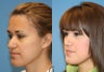 Reduction Rhinoplasty
