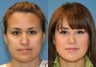 Reduction Rhinoplasty
