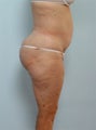 Body Lift