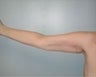Female patient who underwent an arm lift