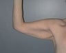 Female patient who underwent an arm lift