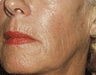Sculptra